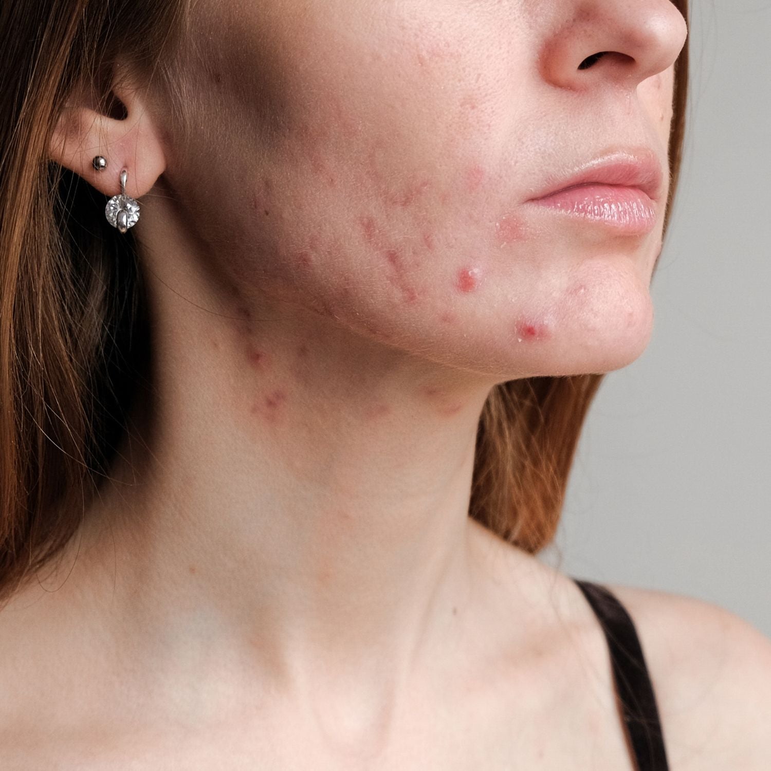 Acne or sensitive